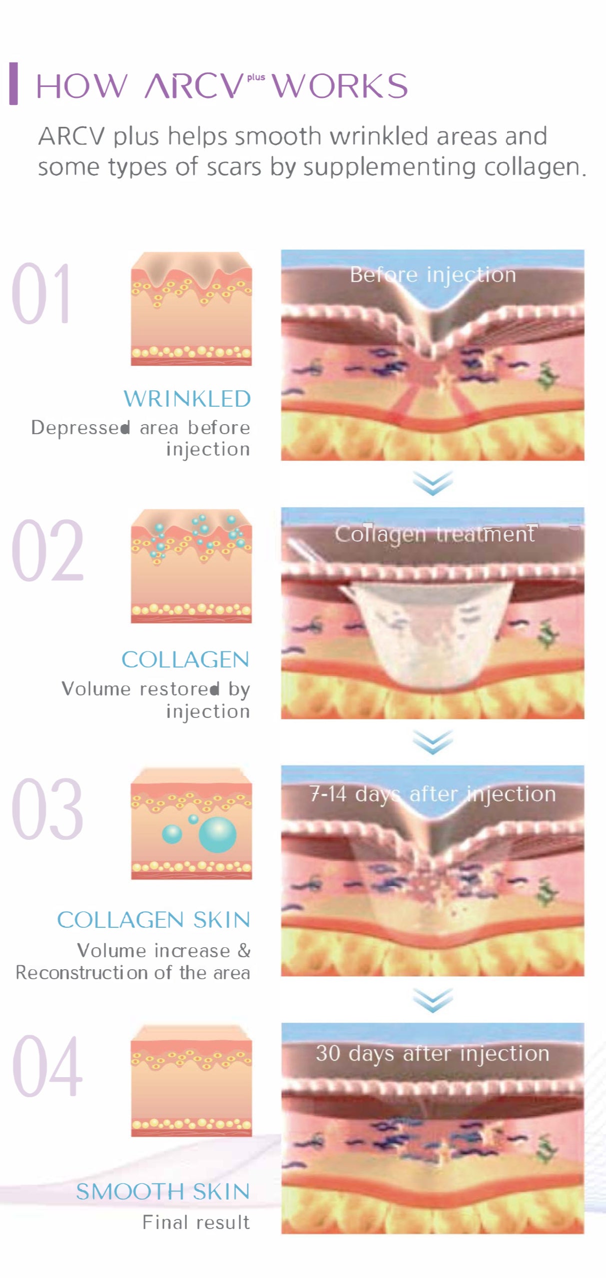 ARCV Plus ATELOCOLLAGEN 3%